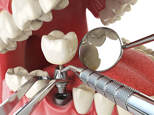 Best Emergency Tooth Extraction in Port Ludlow, WA